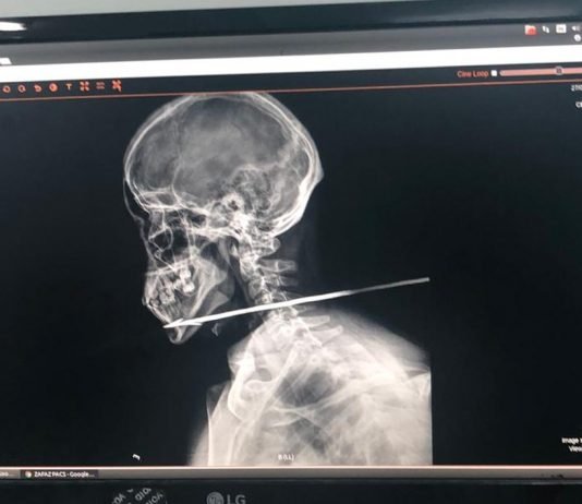 Homem tem pescoço perfurado por flecha ao tentar atravessar fronteira entre a Guiana e o Brasil